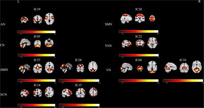 Disrupted intra- and inter-network connectivity in unilateral acute tinnitus with hearing loss